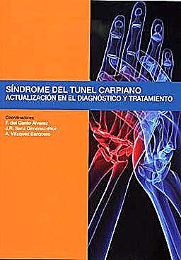 Sindrome Del Tunel Carpiano