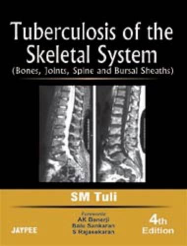 Tuberculosis of the Skeletal System
