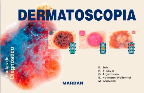Dermatoscopia. Pautas de Diagnóstico