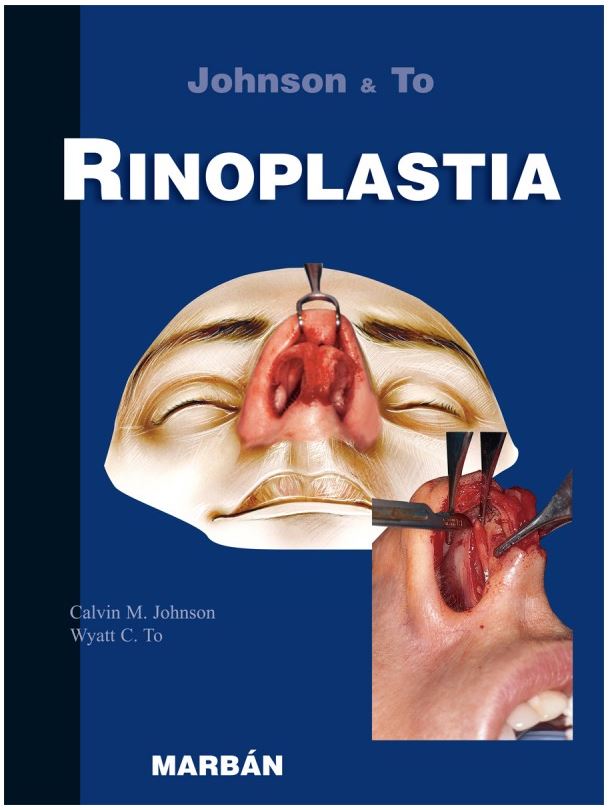 Rinoplastia