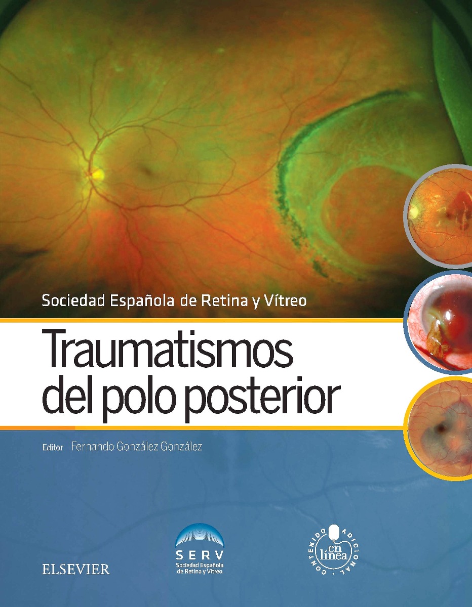 Traumatismos Del Polo Posterior + Acceso Online
