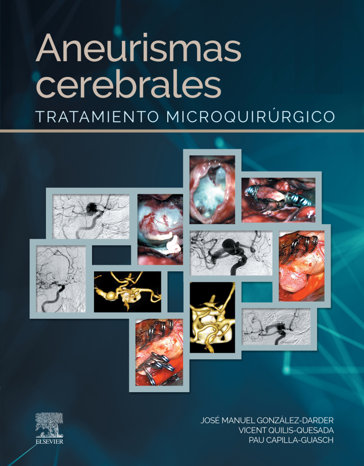 Aneurismas Cerebrales
