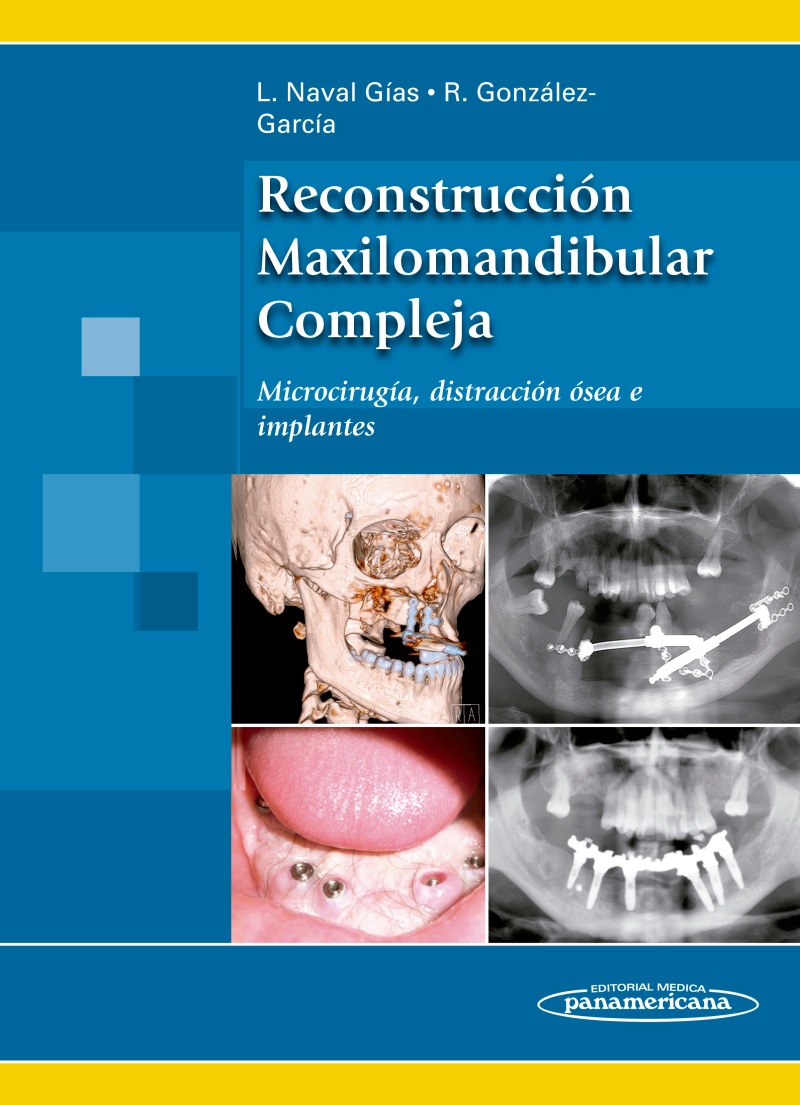 Reconstrucción Maxilomandibular Compleja