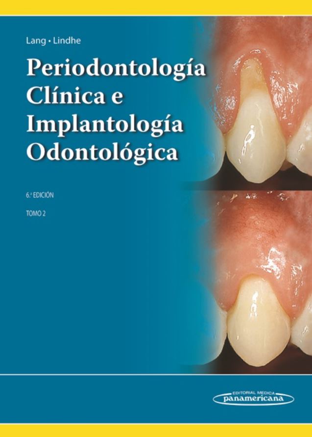 Periodontología Clínica E Implantología Odontológica, Tomo 2