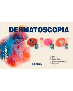 Dermatoscopia. Pautas de Diagnóstico