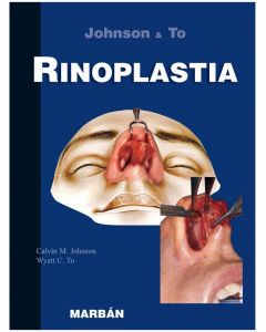 Rinoplastia