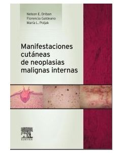 Manifestaciones Cutáneas De Neoplasias Malignas Internas